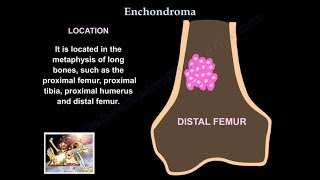 Orthopedic Oncology Course  Introduction to Musculoskeletal Tumors  Lecture 1 [upl. by Bethezel170]