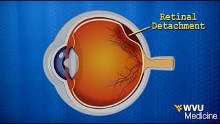 Detached Retina Vitrectomy with Scleral Buckle [upl. by Enilekaj]