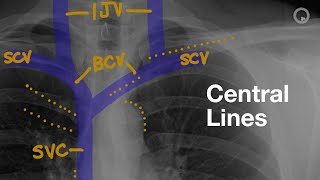 Central Lines on CXR [upl. by Maybelle]