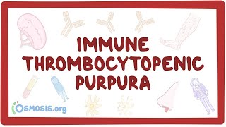 Idiopathic thrombocytopenic purpura ITP  pathology  hematology  platelet disorder English [upl. by Dygal493]