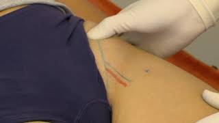 Injection for psoas bursitis [upl. by Odranoel598]