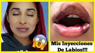 INYECCIONES DE LABIOS CON ACIDO HIALURONICO JUVEDERM LIP INJECCIONS [upl. by Ahsitnauq39]