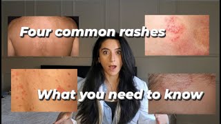 Four common rashes and everything you need to know about them [upl. by Denver]