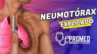 😨NEUMOTÓRAX 👉 Definición Clasificación fisiopatología [upl. by Besnard]