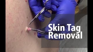 Skin Tag Removal  Dr Derm [upl. by Nnaeerb]