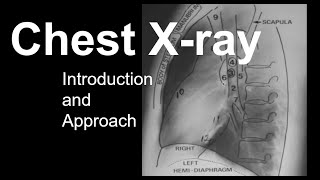 Coronary Artery Calcium Scan Calcium Heart Score Explained [upl. by Dlareme303]