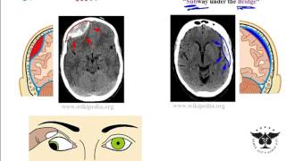 Hemorrhagic stroke epidural amp subdural hematoma  USMLE Step 1 [upl. by Natek]