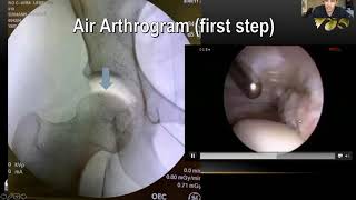 Femoroacetabular Impingement FAI [upl. by Fechter]