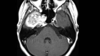 Chondrosarcoma [upl. by Haim154]