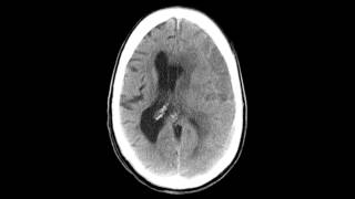 Subdural Hematoma  Before amp After [upl. by Melone790]