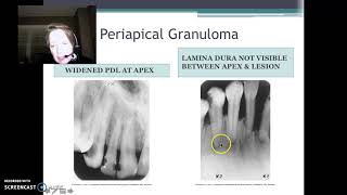 Periapical Radiolucency amp Radiopacity [upl. by Navonoj]