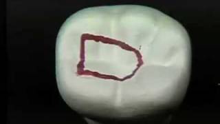 Endodontic Cavity Preparation  Phase I  Posterior [upl. by Kcirddor]