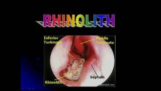 RHINOLITH [upl. by Hinson]