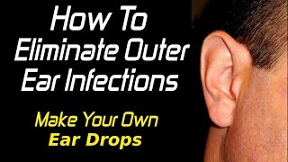 How To Treat Outer Ear Infections [upl. by Naawaj]