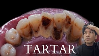 TARTAR [upl. by Nerol51]