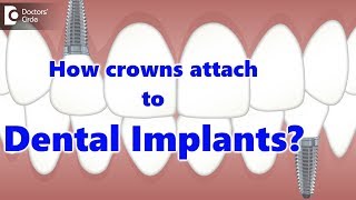 How crowns attach to Dental Implants  Dr Manesh Chandra Sharma [upl. by Asirral896]