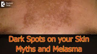 Dark Spots on your Skin  Hormones Vitamin D Melasma  Dr Aruna Prasad [upl. by Daphie]