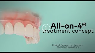 ALLON4 Nobel Biocare Implants Explained [upl. by Odrautse]