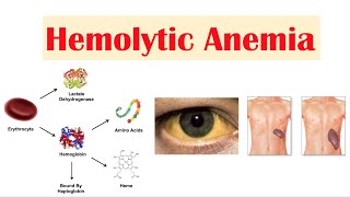 Hemolytic Anemia [upl. by Eerok635]