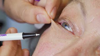 How to GET RID OF UNDER EYE WRINKLES Dr Dray [upl. by Petersen]