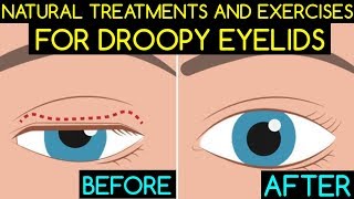 Dr Kotlus tells how to fix a droopy eyelid [upl. by Susy]