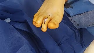 Surgical Correction of Hammertoe deformity [upl. by Madanhoj]