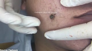 Removing Years Old Blackheads On a Mans Face Easily SS01E01 [upl. by Samaria]