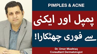 How To Remove Pimples Overnight  Acne Treatment  Pimple Khatam Karne Ka Tarika [upl. by Eyssej]