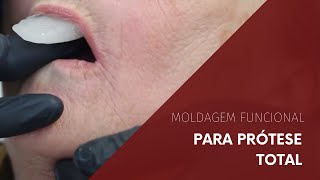 Moldagem Funcional para Prótese Total [upl. by Rawdan481]