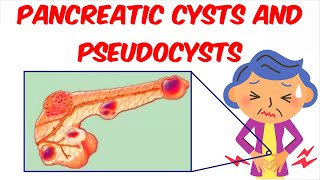 EUS guided Pancreatic pseudo cyst drainage [upl. by Harwin387]