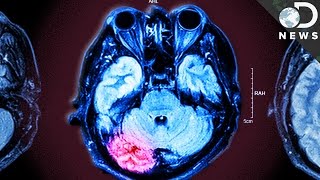 Physical Therapy Exercises After a Concussion [upl. by Oht]