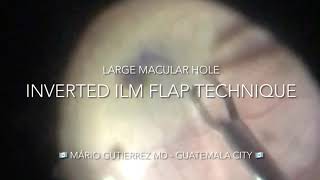 Inverted ILM flap technique for large macular holes [upl. by Sashenka]