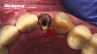 Emergency Repair of Loose Crown [upl. by Debi]