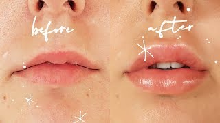 Getting Lip Injections  Before amp After VLOG [upl. by Yeldnarb]