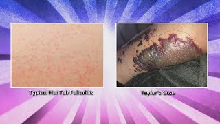 What Puts You at Risk for Hot Tub Folliculitis [upl. by Ellmyer887]