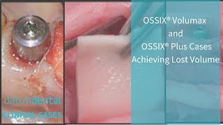 OSSIX® VOLUMAX and OSSIX® PLUS cases [upl. by Ahsinnod]