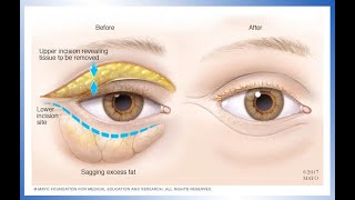 Droopy Eyelid ptosis Treatment and Surgery [upl. by Enohsal]