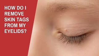 How Do I Remove Skin Tags from My Eyelids [upl. by Aikemot]