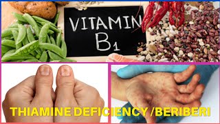 BeriBeri  Thiamine deficiency [upl. by Ahtekal]