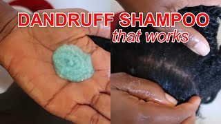 Best SHAMPOO for Dandruff  How to use Nizoral AntiDandruff Shampoo  Discoveringnatural [upl. by Augusta]