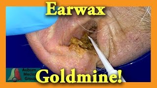 Earwax GOLDMINE  Auburn Medical Group [upl. by Roy]