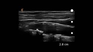 Image Interpretation Carotid Atherosclerosis [upl. by Washington]