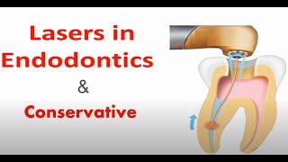 LASERS IN ENDODONTICS AND CONSERVATIVE DENTISTRY [upl. by Doty872]