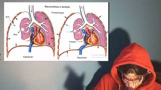 Explicación y APH de Neumotórax a Tensión abierto simple y Hemotórax [upl. by Mossolb]
