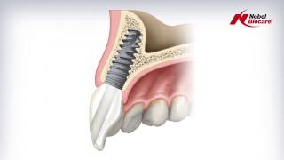 Angulated Screw Channel ASC Abutment [upl. by Gnos]