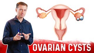 Ovarian Cysts Causes Symptoms amp Natural Treatment – DrBerg [upl. by Nore]