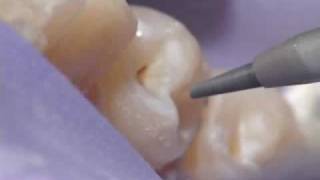 Dental Air Abrasion  Denville NJ [upl. by Rodriguez348]