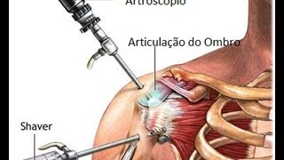 Cirugia no ombro explicações e informações [upl. by Lamoree]