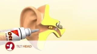 How to use Otex Ear Drops [upl. by Ecnahc633]