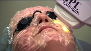 IPL Skin Rejuvenation by Jeffrey Klein MD Dermatology and Associates [upl. by Nodnahs]